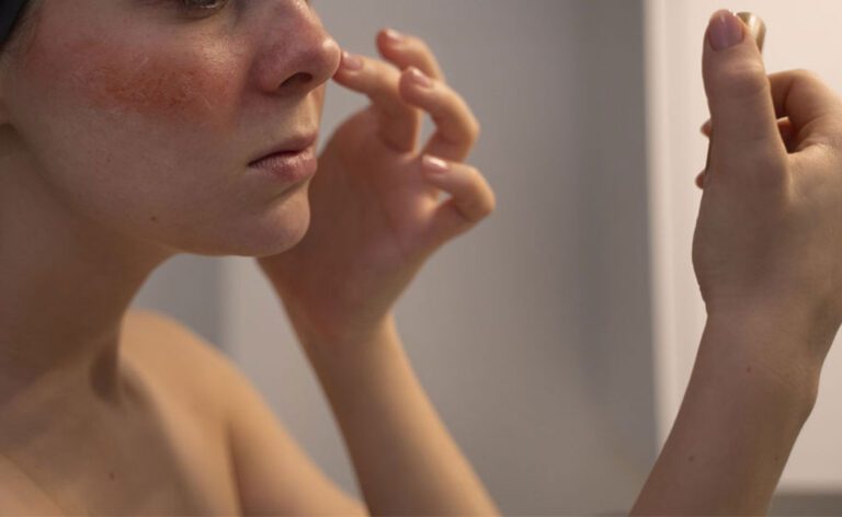 Understanding Rosacea: Symptoms, Triggers, and Treatments
